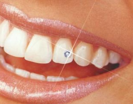 Скидка 56% на систему для домашнего отбеливания зубов White Light! Улыбайтесь чаще!